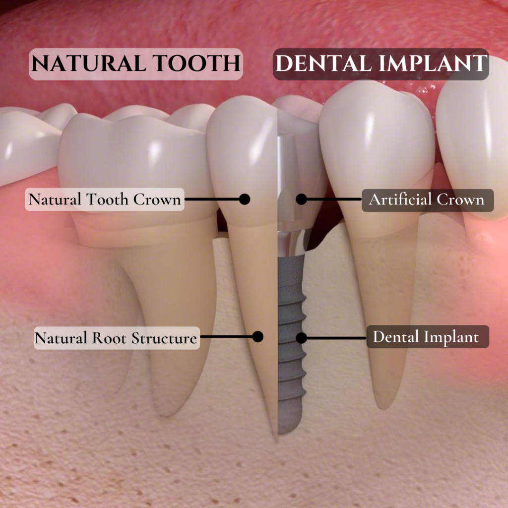 illustration of a dental implant