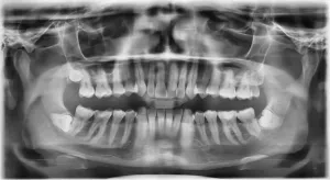 panoramic x-ray of a mouth