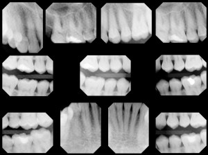 x-rays of teeth