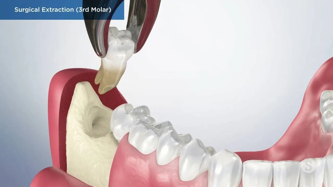 Surgical Extraction (3rd Molar) Video Thumbnail